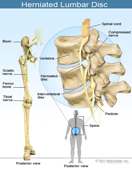 Disc Herniation in the Lower Back